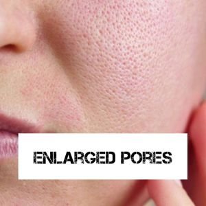 Enlarged Pores