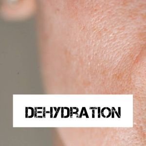 dehydration